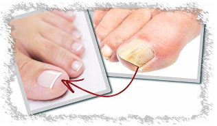 Causes of nail fungus