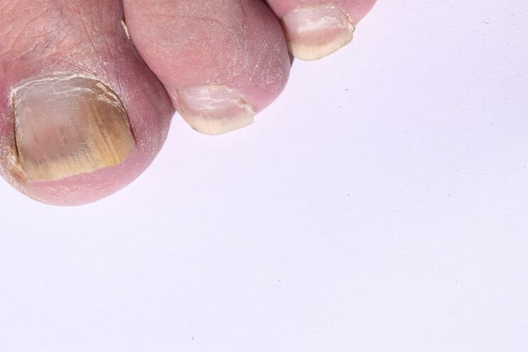 Early stages of toenail fungus