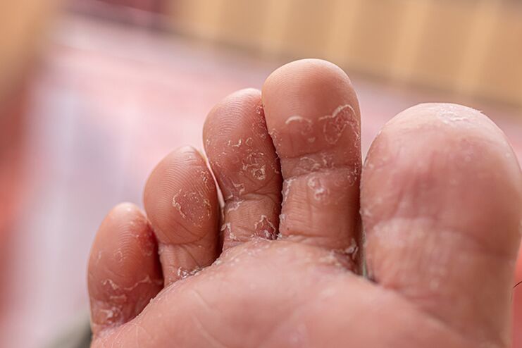 Fungus on finger skin-initial stage