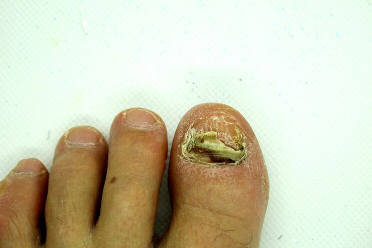 Toenail fungus-severe stage