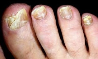 The danger onychomycosis