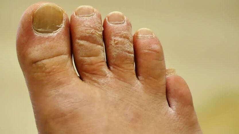 Squamous toenail fungus