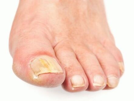 Fungus on the feet damages the nails