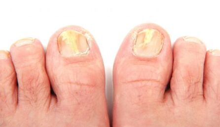 Manifestations of toenail fungus