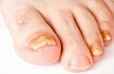 Toenails turn yellow due to fungus