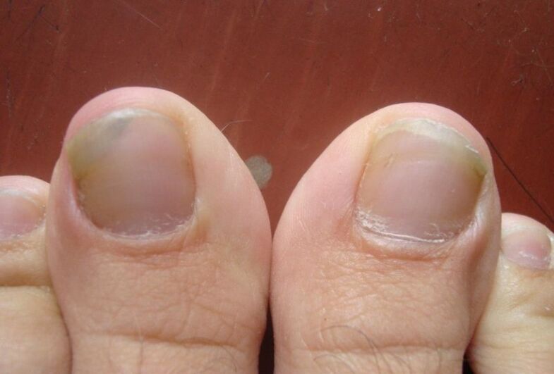 Early stages of toenail fungus