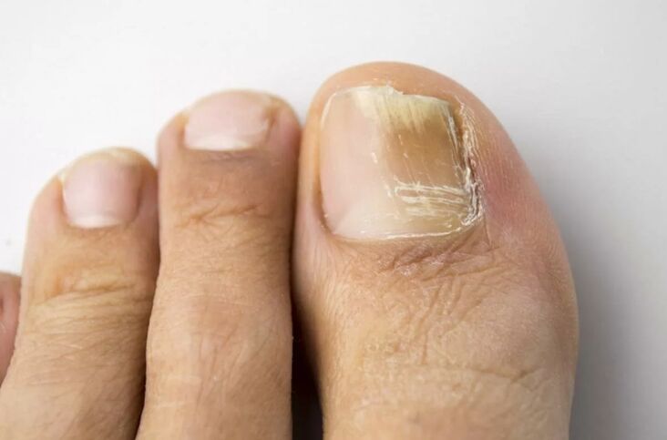 Nails on the legs