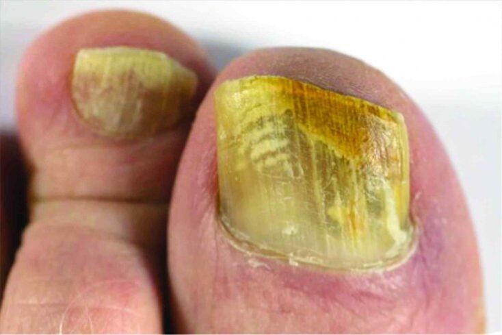 The feeling of nails on the legs