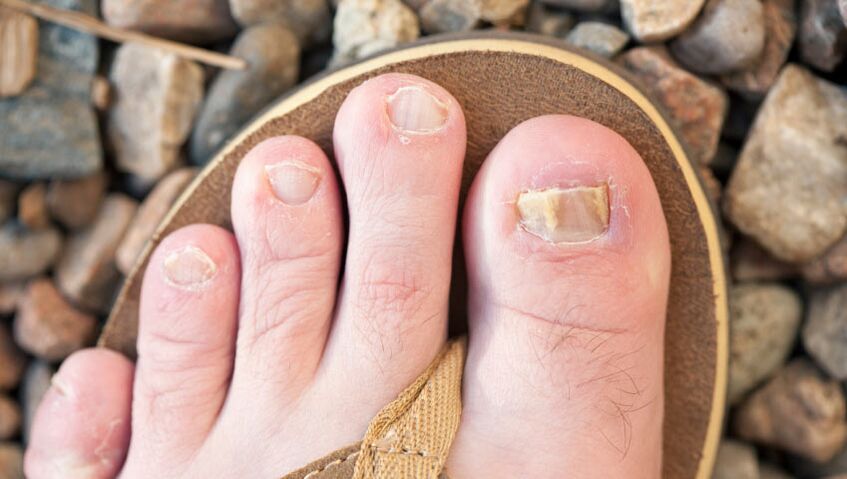nail